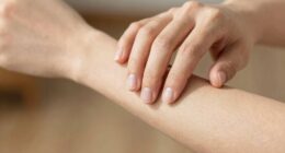 properly manage scratch urges